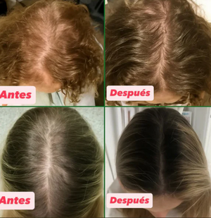 ¡TRATAMIENTO ANTICAIDA DEL CABELLO! - RECUPERALO YA